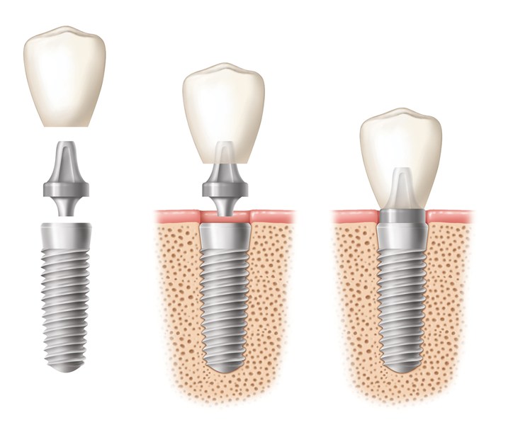 Implant-Components