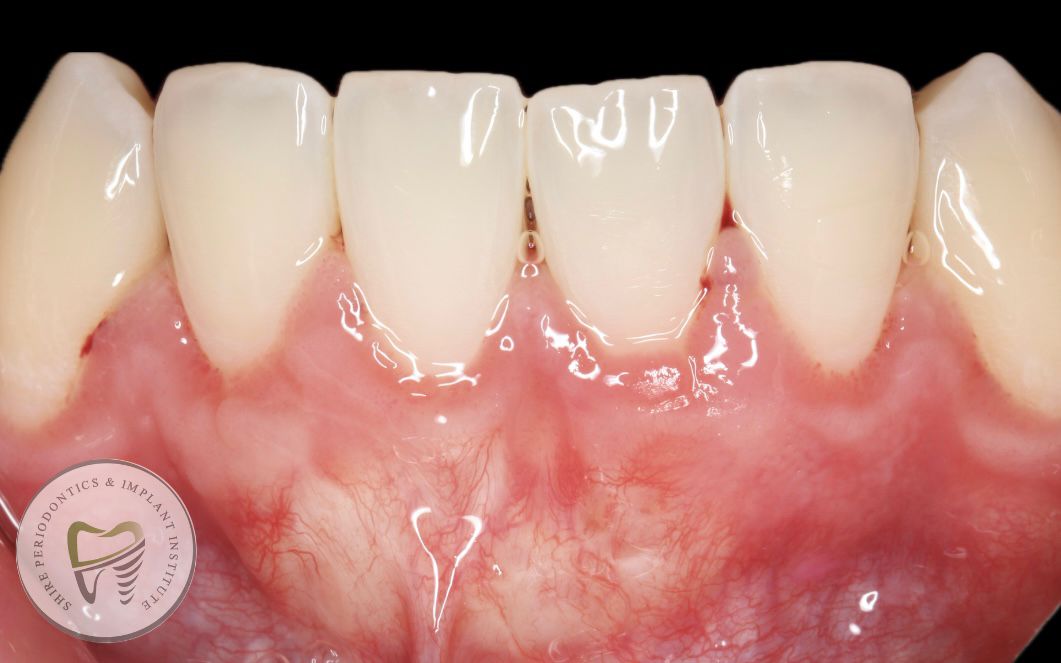 Shire Periodontics Gum Recession After