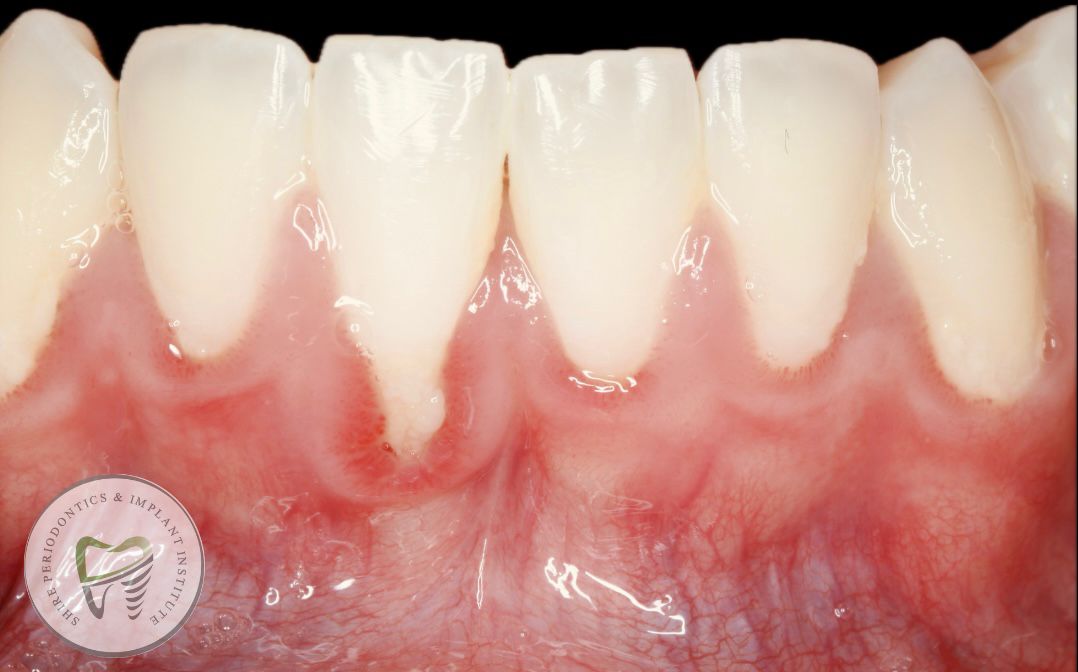 Shire Periodontics Gum Recession Before